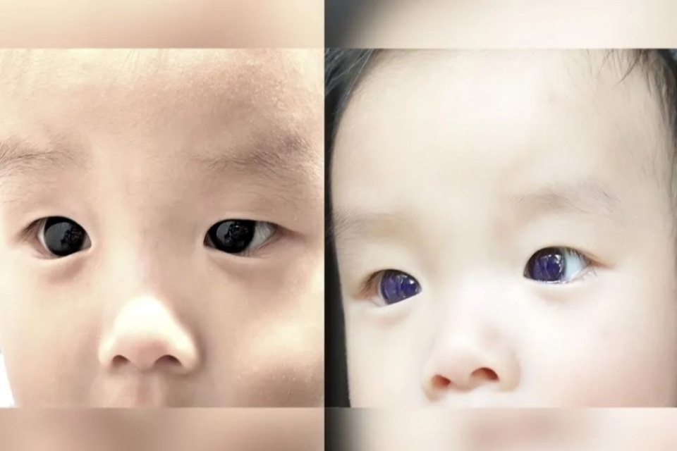 驚！6個月大男嬰服用「法匹拉韋」治療新冠病毒 竟黑眼變藍眼