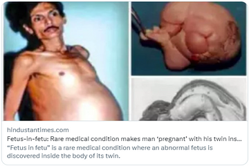 從小就肚子大！印度男剖腹後驚見「4公斤死胎」：有四肢跟頭髮